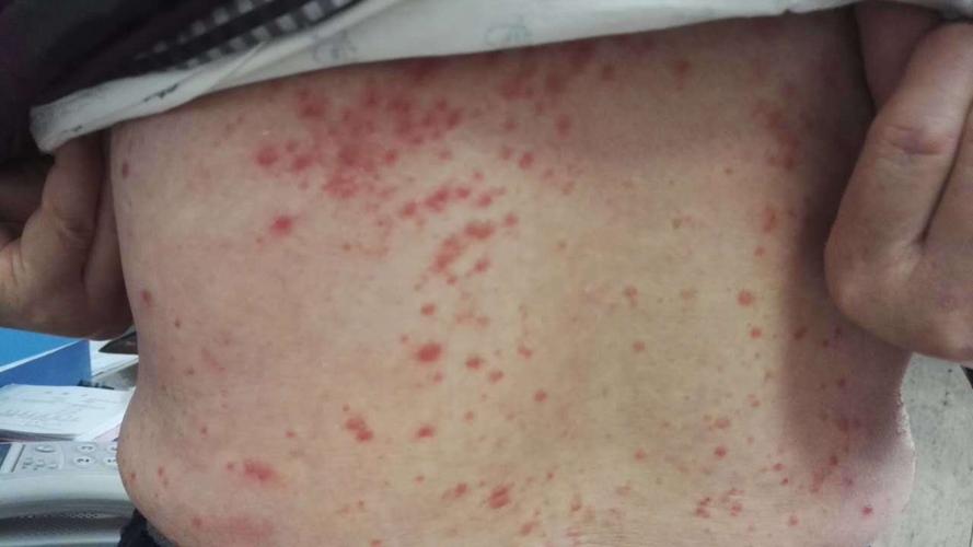 我的第一次接受严重皮肤病的挑战