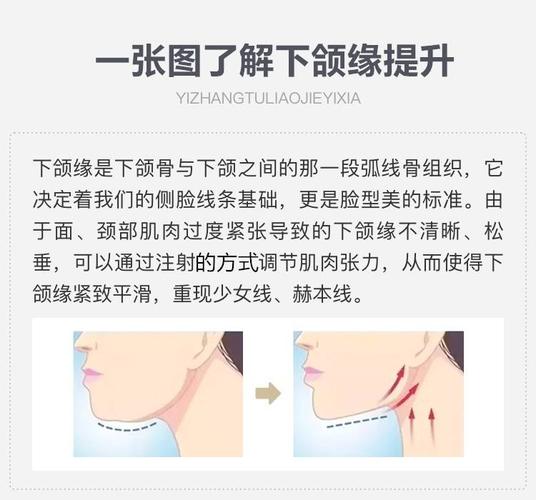 衡力轮廓针 下颌缘紧致提升/瘦脸/赫本线/少女线 医学博士注射 无隐形
