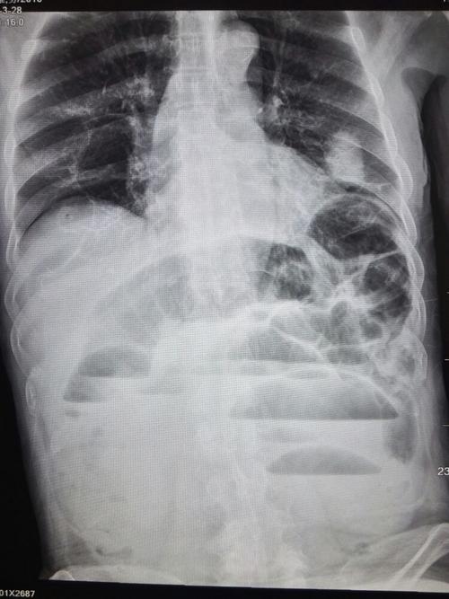 一机医院介入室成功实施一台经鼻肠梗阻导管置放术