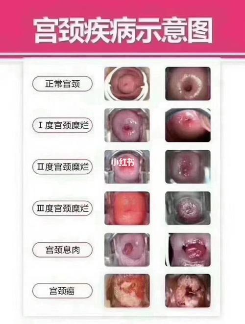 宫颈糜烂 一度 二度 三度_宫颈糜烂_医疗健康_医疗