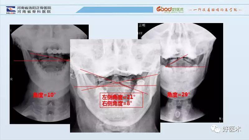 寰枢关节半脱位诊断