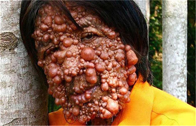 全身肿瘤面部图片