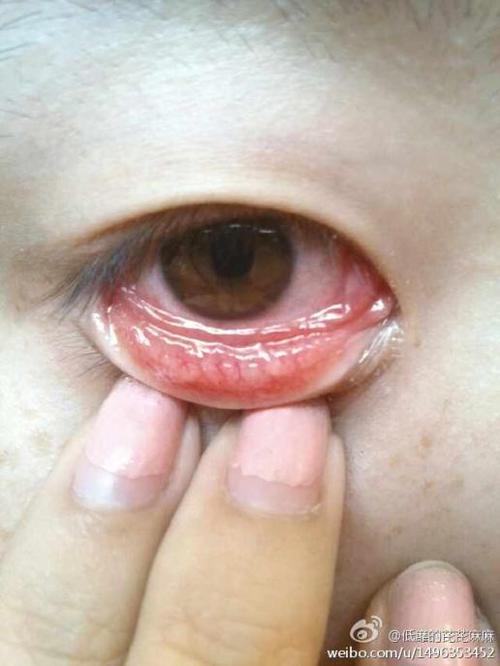这是沙眼么?还是结膜炎?