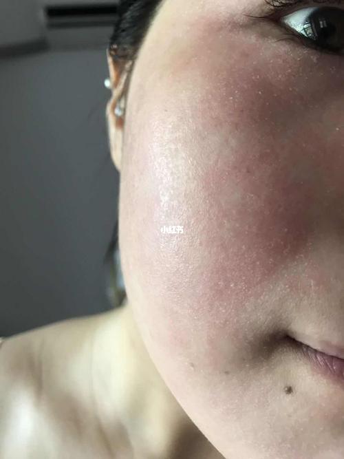 脸总过敏,红肿痒疙瘩好多怎么办?_护肤_痘痘_美妆_护肤_护肤其他