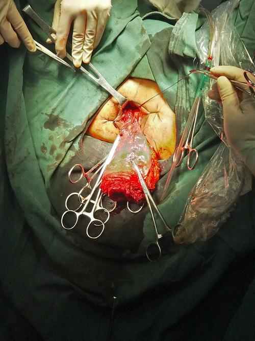 康利医院直肠脱垂手术