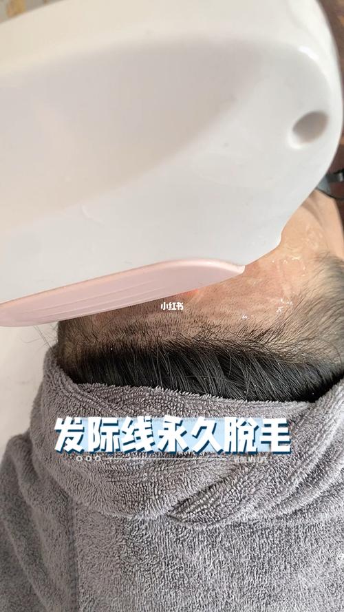 发际线永久脱毛,露出额头,招财_脱毛_发际线_新东方怎么样_美女_美妆