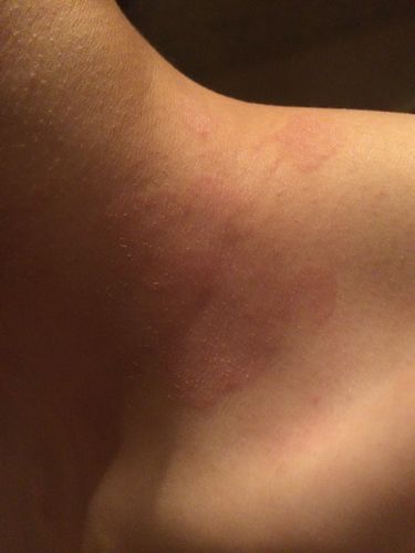 问:脖子周围长一块块红斑很久了不会完全消失有时候会淡有时候会红 这