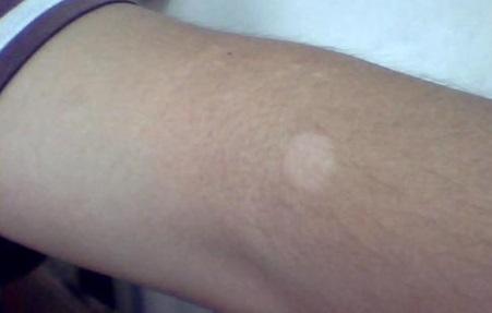 这是因为手臂属于外露部位,很容易受到外界的刺激,导致黑色素不能正常