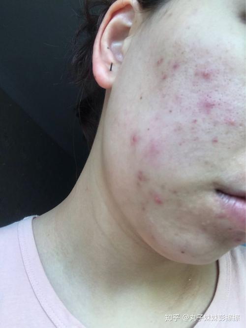发炎红肿痘痘和红痘印怎么办?