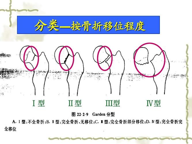股骨颈骨折的护理查房ppt