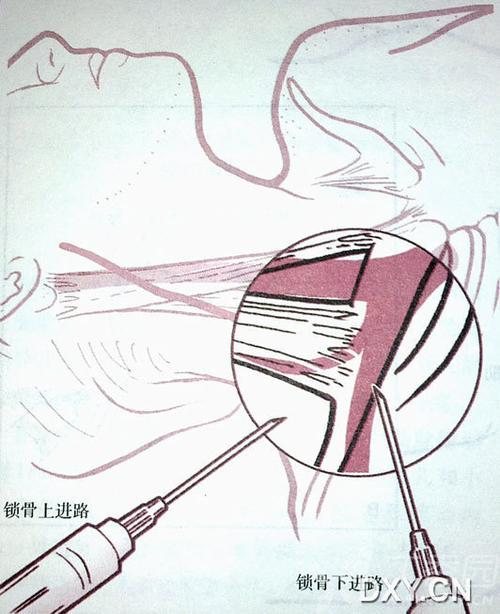 锁骨下静脉及颈静脉穿刺