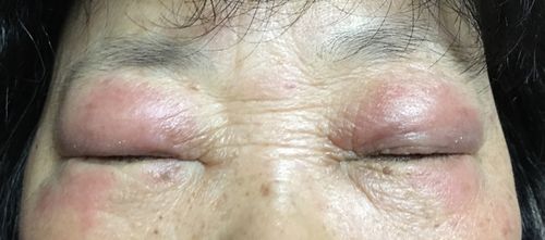 期间去复旦大学眼耳鼻喉医院看过,说是过敏,配了药膏和眼药水.