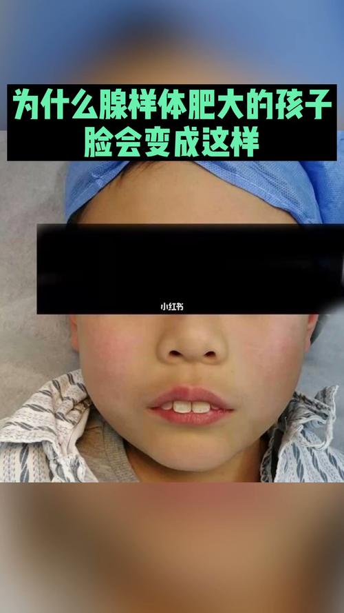 腺样体肥大的孩子为什么脸会慢慢变成这样_腺样体肥大