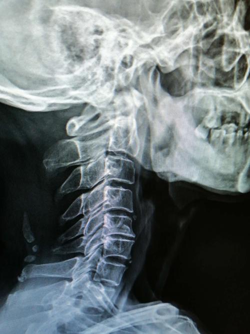 ct颈椎照片12月7日