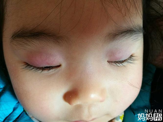 宝贝长了麦粒肿怎么办?