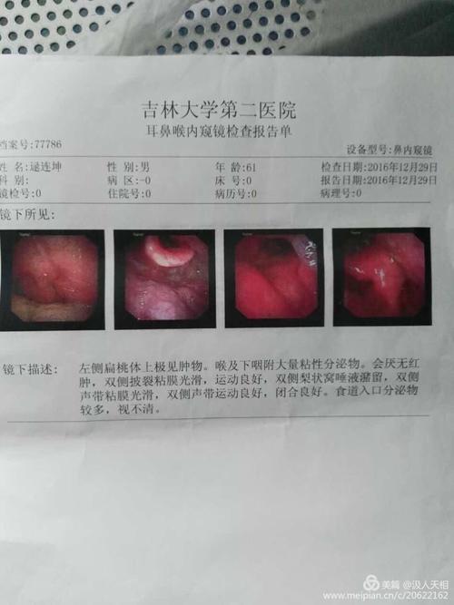 滚蛋吧【扁桃体恶性肿瘤】