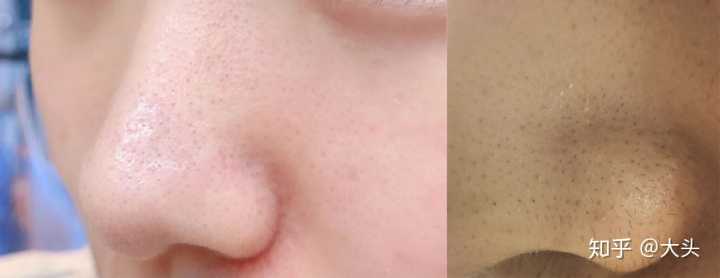 有什么好用的去黑头产品吗?