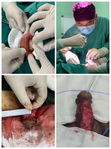 张家界市人民医院成功完成一例复杂性尿道狭窄修复手术.