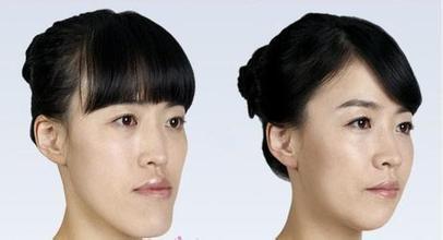 地包天不矫正是否可以呢?