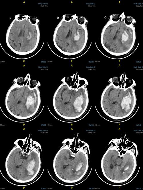 ct提示左侧基底节,丘脑,颞叶,枕叶广泛性脑出血.