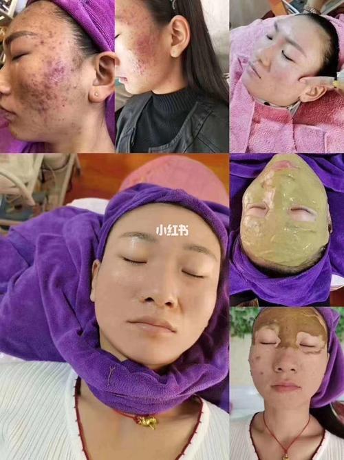 中药面膜的效果是:排毒去黄,美白淡斑. 原理:面膜融合