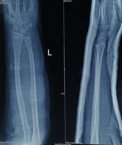 对于小孩尺桡骨青枝骨折,切勿暴力复位,慢工出细活,同样可以达到