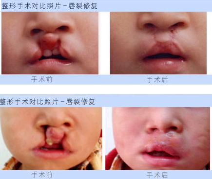 兔唇的最佳治疗时间是何时?