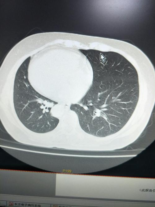 我县首例右位心冠脉造影术