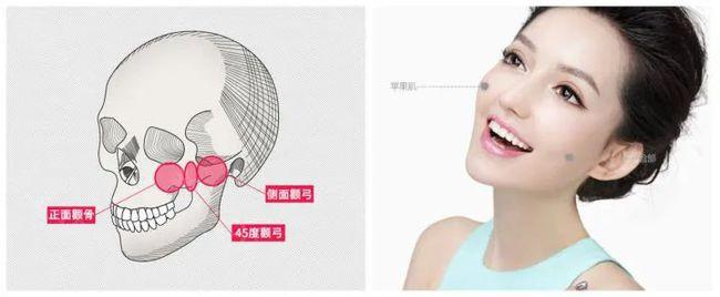 颧骨是骨相美的关键;范芳医生谈颧部之美