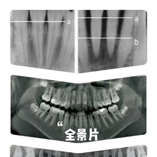 黑乎乎的牙片要怎么看?这份指南请收好(一)_口腔_牙医