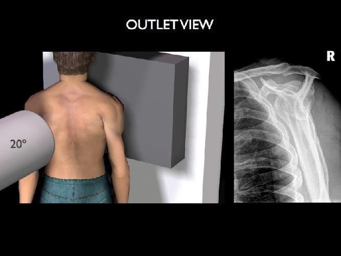 建议您一定要到医院进行 肩关节的x线检查,明确肩峰的形态,如果没有