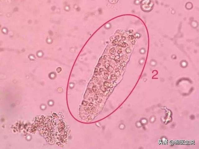 尿液中肉眼看不到的有形成分,为什么肾病都在查它?