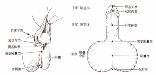 如何判断尿道下裂是否严重及尿道下裂的分型