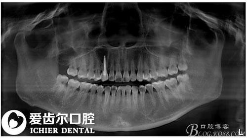 一例成功的根尖囊肿摘除术(附图附说明)
