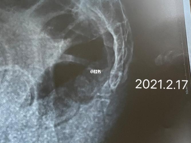 尾椎骨骨折_医疗健康_医疗健康其他