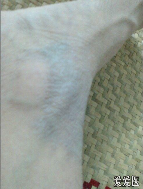 看图诊病水源性角化病