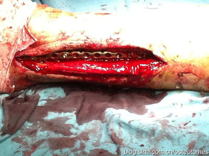 血友病人骨折二例