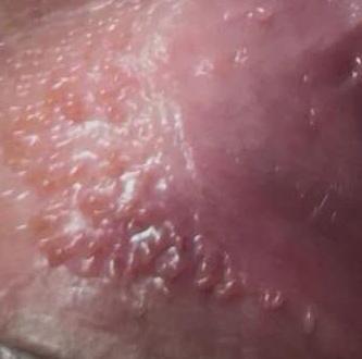 假性湿疣与尖锐湿疣辨别图(密集恐惧勿点)