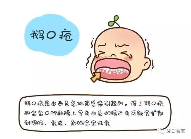 口腔炎气雾剂适用于小儿常见口腔炎症鹅口疮