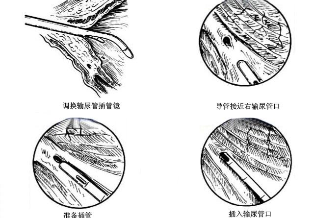 图解膀胱镜检查术过程手术图解