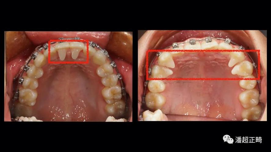 如果上前牙非常舌倾也可将树脂平导粘在3,4上