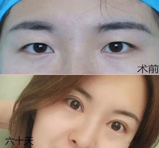 眼睛变好看,不只是割个双眼皮就能解决的,眼综合都包括什么?