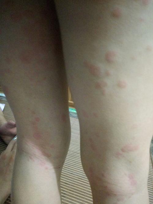 有谁知道这是怎么回事吗?小孩子腿上长的