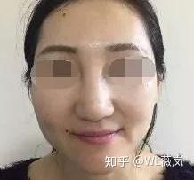 【vl科普】哪些情况下注射玻尿酸隆鼻,鼻梁会变宽?