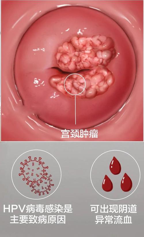 宫颈这5种"病"|宫颈糜烂|真的不用"治"!|囊肿|炎症