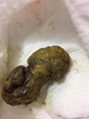 "/item/大便/565933" data-lemmaid="565933">大便 /a>带血是指排便时