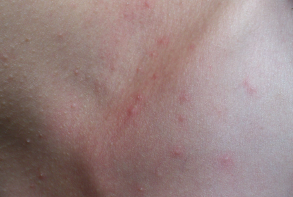 皮肤过敏有什么样的症状 皮肤过敏应该如何进行预防