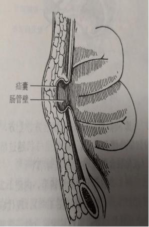 疝气的病因是由于正常腹股沟区域腹壁存在缺损或者薄弱,腹腔内脏器经