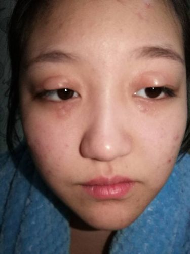 眼睛特别痒 挠完之后起了很大的水泡 越来越大