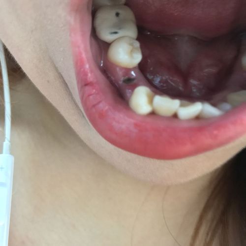 拔牙第六天 这个创面正常吗